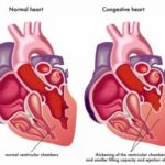 Are bananas good for congestive heart failure?