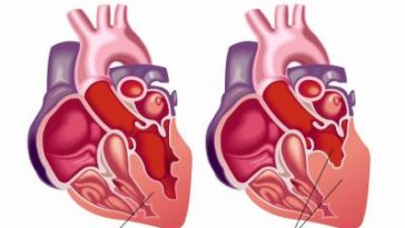 Are bananas good for congestive heart failure?