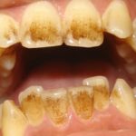 Are coffee stains permanent on teeth?
