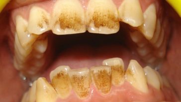 Are coffee stains permanent on teeth?