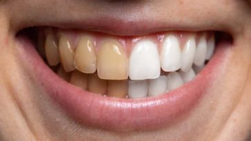 Are coffee teeth stains permanent?