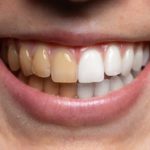 Are coffee teeth stains permanent?