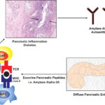 Can autoimmune pancreatitis be cured?