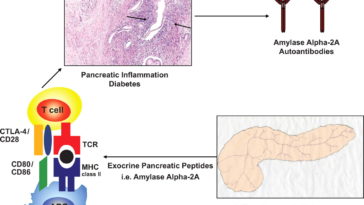 Can autoimmune pancreatitis be cured?