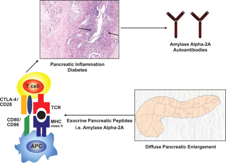 Can autoimmune pancreatitis be cured?