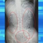 Can boba clog your intestines?