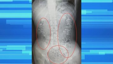 Can boba clog your intestines?