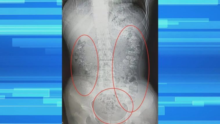 Can boba clog your intestines?