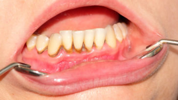 Can you scrape tartar off your own teeth?