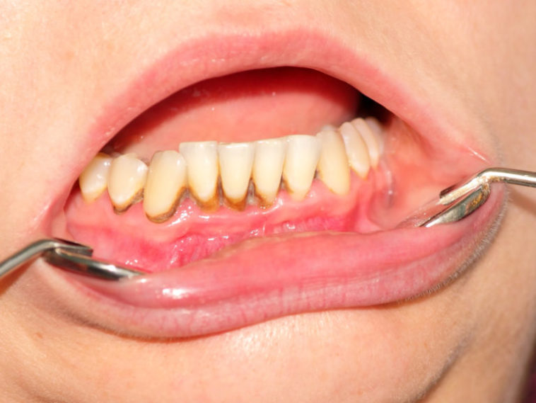 Can you scrape tartar off your own teeth?