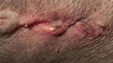 Do I need to take my dog to the vet for a hot spot?