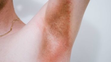 Does KY jelly cause yeast infections?