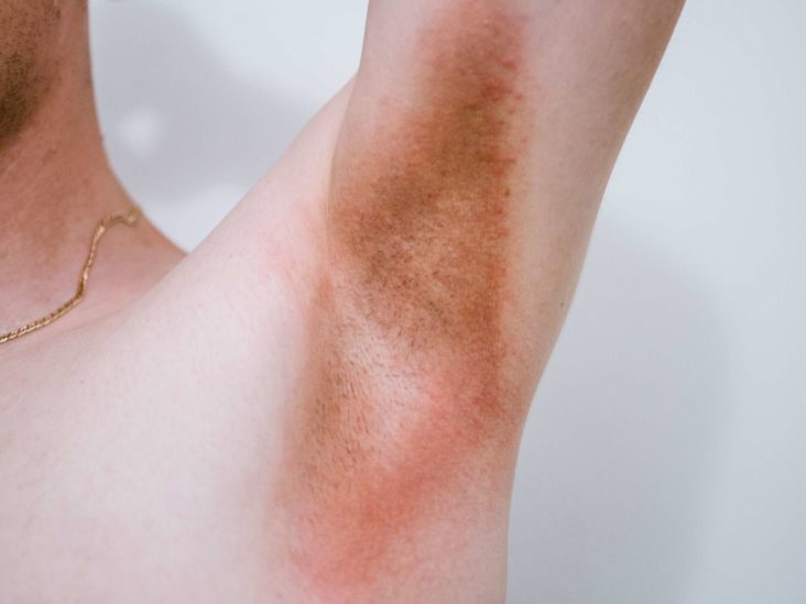 Does KY jelly cause yeast infections?