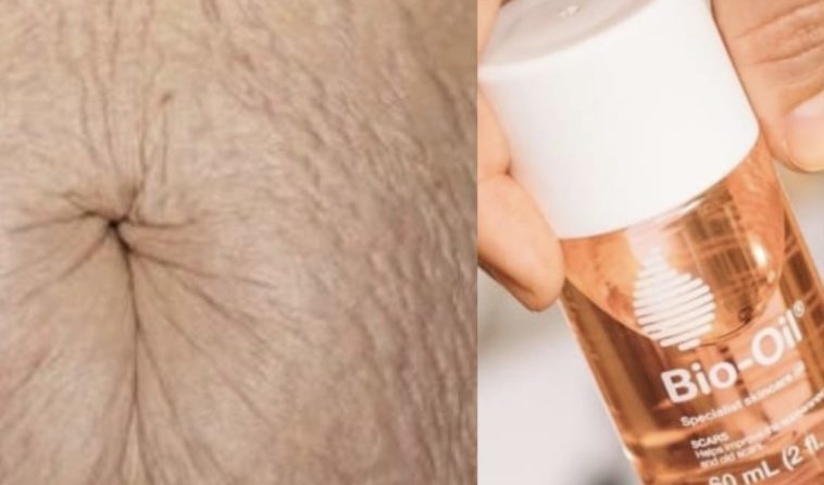 Does carrot oil clear stretch marks?