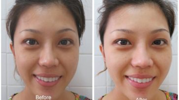 Does drinking water help acne?