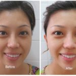 Does drinking water help acne?