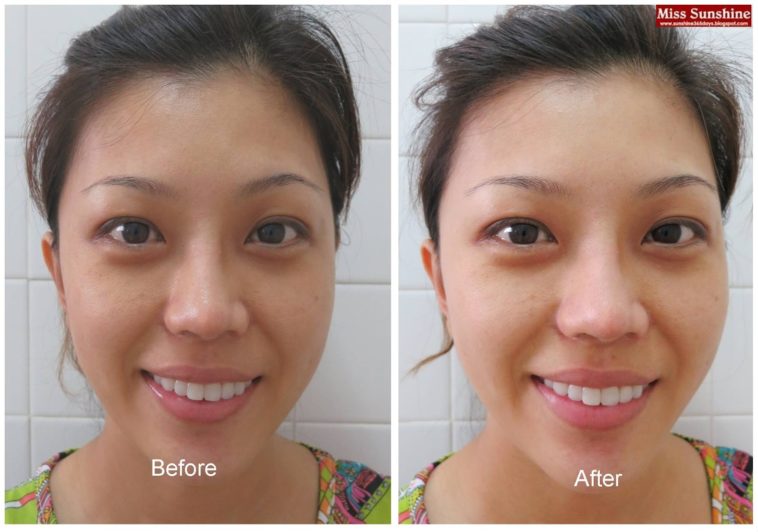 Does drinking water help acne?