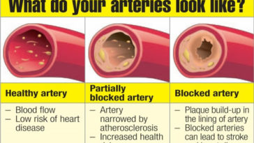 Does lard clog arteries?