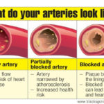 Does lard clog arteries?