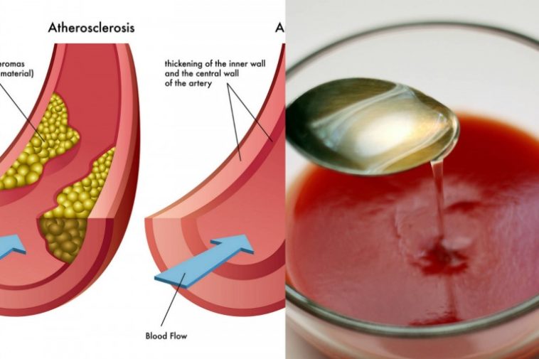 Does lemon juice clean your arteries?