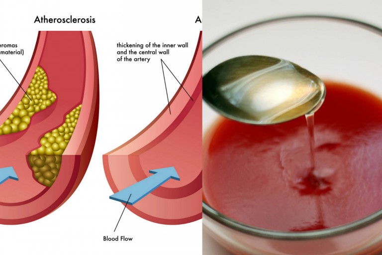 Does lemon juice clean your arteries?