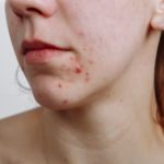How do I stop pimples on my face?
