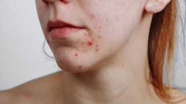 How do I stop pimples on my face?