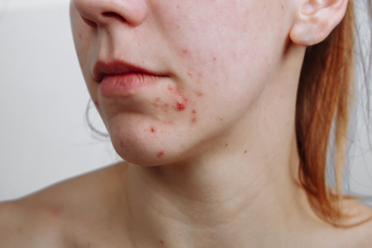 How do I stop pimples on my face?