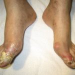 Is beef tongue bad for gout?