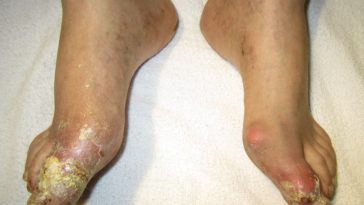 Is beef tongue bad for gout?