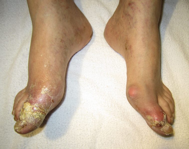 Is beef tongue bad for gout?