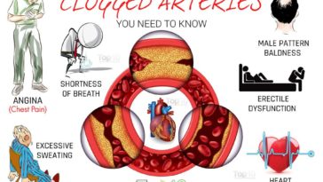 What age do arteries start to clog?