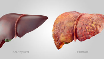 What alcohol is easiest on liver?