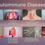 What are the 7 autoimmune diseases?