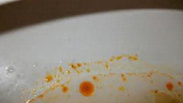 What does malabsorption poop look like?