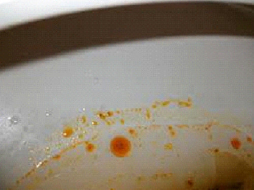 What does malabsorption poop look like?