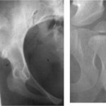 What happens if hip dysplasia is left untreated?