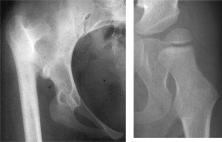 What happens if hip dysplasia is left untreated?