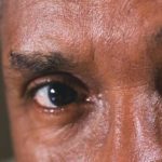 What is an eye stroke?