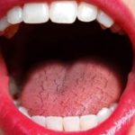 What should I eat for dry mouth?