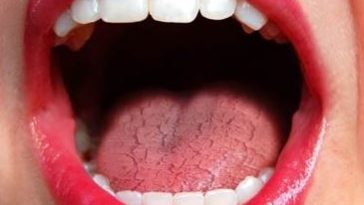 What should I eat for dry mouth?
