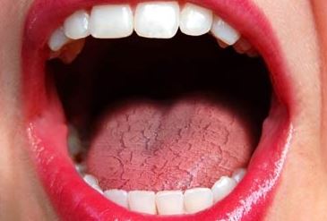 What should I eat for dry mouth?