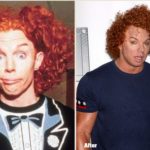 Why did Carrot Top plastic surgery?