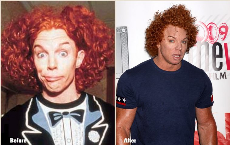Why did Carrot Top plastic surgery?