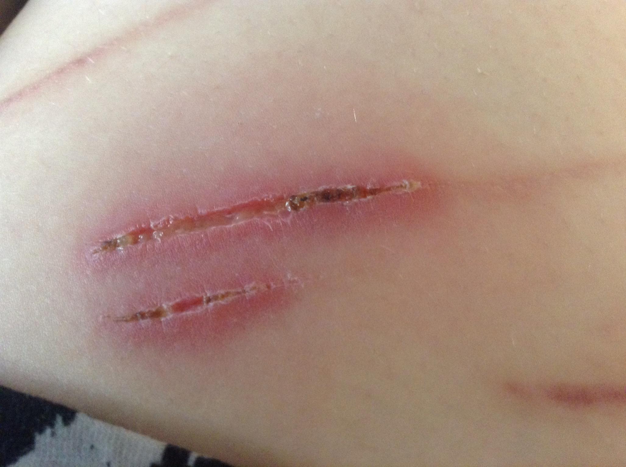 What Can Happen If A Cut Gets Infected