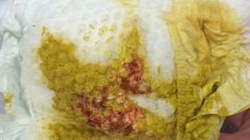 What does lactose intolerance poop look like?