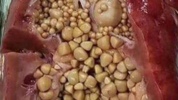 Can loaded teas cause kidney stones?