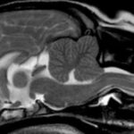 Does Chiari malformation shorten lifespan?
