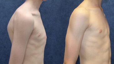 How common is pectus Carinatum?