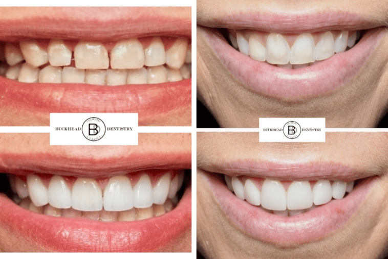 How much do veneers cost?